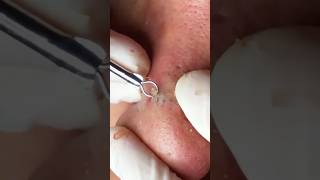 Éclatement de Boutons Extrêmeblackheads acne asmrvideo [upl. by Kowalski]