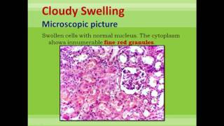 Cell Response to Injury 2nd pathology lecture [upl. by Eilojne]