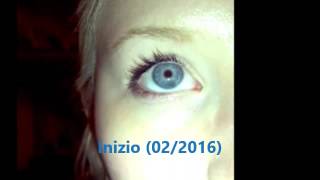 NISTAGMO CONGENITO CONGENITAL NYSTAGMUS [upl. by Nylrahs322]