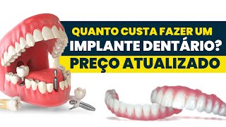 Quanto custa um IMPLANTE DENTÁRIO em 2022 [upl. by Piggy]