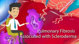 Relationship between Scleroderma and Pulmonary Fibrosis [upl. by Ayatal708]