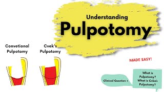 Pulpotomy and Cveks Pulpotomy  Endodontics [upl. by Ahso870]