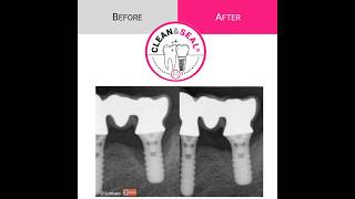 How to treat periodontitis amp periimplantitis nonsurgically with CLEANampSEAL [upl. by Eterg]