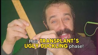 🦱Hair TRANSPLANTs 🐤Ugly Duckling [upl. by Yordan19]