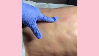 Fibrosis Treatment after liposuction [upl. by Halverson]