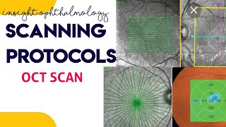 OCT SCANNING PROTOCOLS made easy  line scan macular cube raster scan [upl. by Auohs]