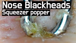 30 Pull out Blackheads on nose squeezer popper Whiteheads Close up 150X  non sound FX ver [upl. by Holloway]