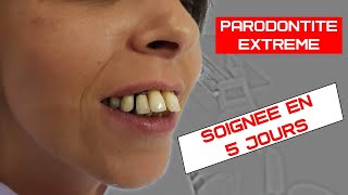 Soigner la parodontite avec perte de gencive  Implants dentaires basales non invasif [upl. by Ardle]