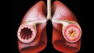 corticosteroids for asthma [upl. by Dav]