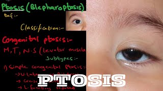 What is Ptosis  Droopy eyelid   it’s types and treatment  detailed explanation [upl. by Suryc514]