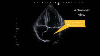 Atrial septal aneurysm [upl. by Avin]