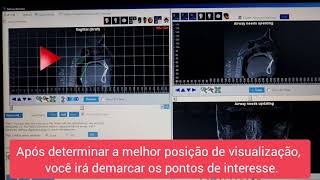 TUTORIAL  CÁLCULO DO VOLUME DA OROFARINGE  SOFTWARE DOLPHIN IMAGING 1195 [upl. by Llertnod]