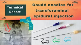 Transforaminal epidural steroid injection using Coudé needle A technical report Video  153 [upl. by Nickelsen]