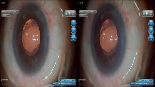 Redialing and optic capture Dr Sourabh Patwardhan Live Cataract surgery For 7028402375 [upl. by Anelle]