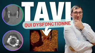 Une valve TAVI qui dysfonctionne après 2 ans  thrombose ou endocardite [upl. by Nettle178]