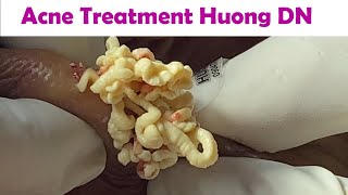 Acne Treatment Huong Da Nang  2024 Acne Huong 715 [upl. by Einalam529]