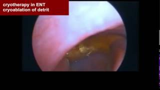 CRYOSURGERY in ENT [upl. by Ynnaffit]