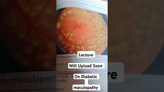 Diabetic maculopathy  Lecture Will Uploaded Soon diabeticretinopathy [upl. by Anisah857]