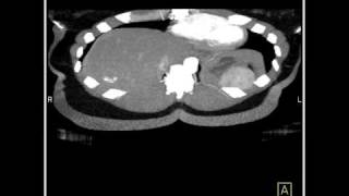 Abdomen Liver Hemangioma of the Liver4 of 8 [upl. by Romelle]