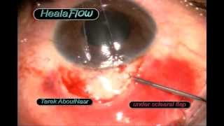 New glaucoma injectable implant Healaflow in Trabeculectomy surgery [upl. by Neelyhtak]