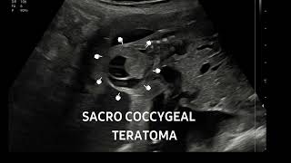 Sacrococcygeal teratoma at 22 weeksFollowup of this case httpsyoutubeYa59lnLs [upl. by Enoryt]