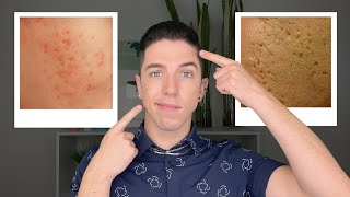 How to Get Rid of Acne Scars [upl. by Ellord]