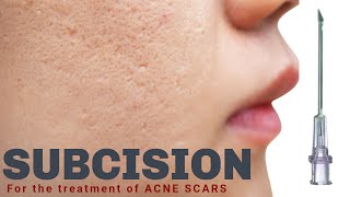 Subcision for Acne Scars  Advanced Dermatology amp Laser Institute of Seattle [upl. by Leda473]