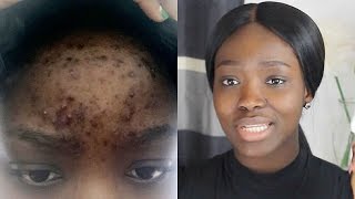 HOW TO  CLEAR ACNE ON A BUDGETReal Life Quick Results [upl. by Nuhsed]