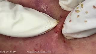 Big Cystic Acne Blackheads Extraction Blackheads amp Milia Whiteheads Removal Pimple Popping [upl. by Akeenat]