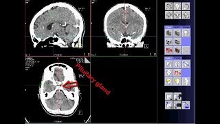 CT scan of pituitary gland techniq [upl. by Els]