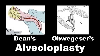 Deans Alveoloplasty amp Obwegeser Alveoloplasty [upl. by Adlin983]