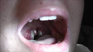 A case of severe tonsillitis [upl. by Lasser599]