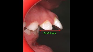 Amazing two phase treatment of Sever Class II Div 1  lama 10Y [upl. by Anneh]