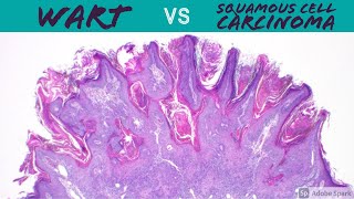 Wart vs Squamous Cell Carcinoma Dermpath Pathology Dermatology Verruca Seborrheic Keratosis SCC [upl. by Aserehs]