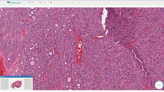 Oncocytic Hürthle Cell Adenoma  Thyroid Gland Histopathology [upl. by Anilys]