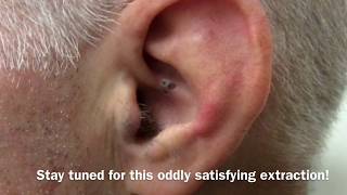 Ear Blackhead Extraction  Dr Steven Greene in Seattle [upl. by Kathlin7]