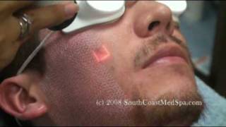 Active FX Laser Acne Scars Removal [upl. by Cale]