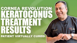 Cure for Keratoconus with Crosslinking and CREATE Protocol No more cone [upl. by Alaecim80]