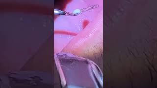 Deep Tonsil Stone Removal  Tonsil Stones  Tooth Time Family Dentistry New Braunfels Texas [upl. by Ardnahcal429]