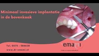 Implantaat implantatie in de kaak [upl. by Aihsemak]