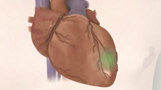 Ischemic Heart Disease [upl. by Evelyn]