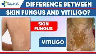 Tinea versicolor Fungal Infection vs Vitiligo Safed daag ka ilaaj  Kayakalp Global [upl. by Anul425]