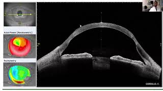 Lecture Keratoconus Worldwide Understanding the Diagnostic amp Therapeutics Alternatives [upl. by Rainwater490]