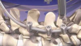 MIS Spine Fixation  Medical amp Scientific Video Production [upl. by Pedrick956]