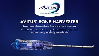 Avitus® Bone Harvester – 6mm Edition Product Launch  Calcaneus Demo [upl. by Okemak862]