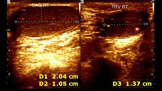 Cryptorchidism in children  Testicular Microlithiasis  Undescended testis [upl. by Ennovy110]