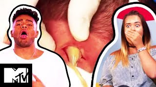 An Amazing Pus Rocket Erupts From A Man’s Massive Neck Boil  What The Yuck Ep 2 [upl. by Anoyk]