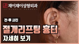 절개리프팅 흉터 자세히 보기  제이제이성형외과 [upl. by Justino]