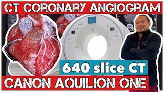 CT CORONARY ANGIOGRAM  CANON AQUILION ONE  640 Slice CT [upl. by Myers]