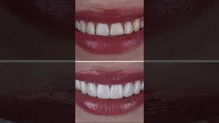 The difference in composite veneers and porcelain veneers [upl. by Okeim]